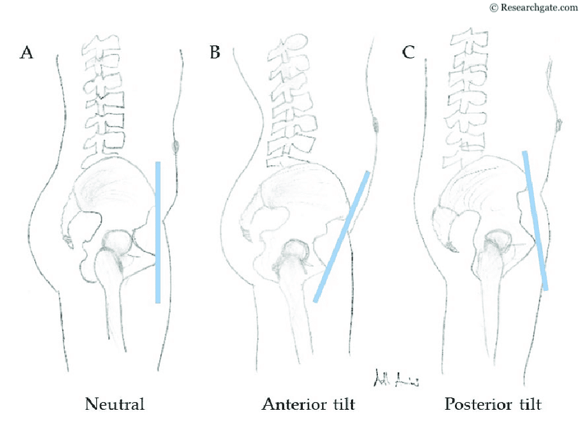 3 side ways views the low back, pelvis and the top of the femur. The one on the left is of neutral pelvic position. The on tin the middle shows an anterior pelvic tilt and the one on the right shows a posterior pelvic tilt.